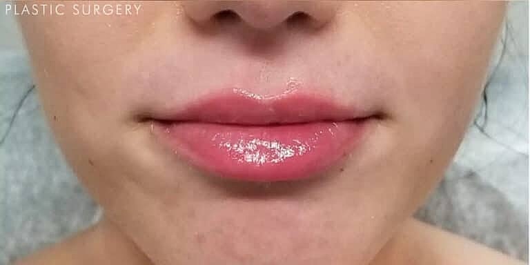 Juvederm Before & After