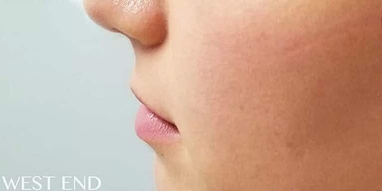 Juvederm Before & After