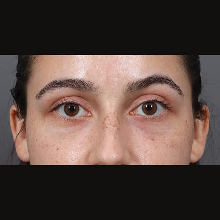 Juvederm Before & After