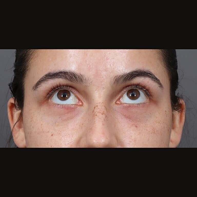 Juvederm Before & After