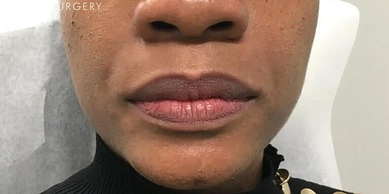 Juvederm Before & After