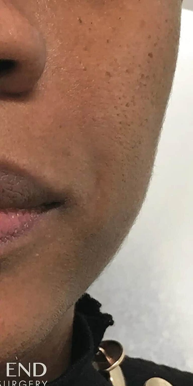 Juvederm Before & After