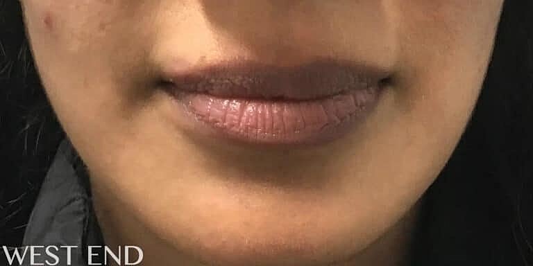 Juvederm Before & After