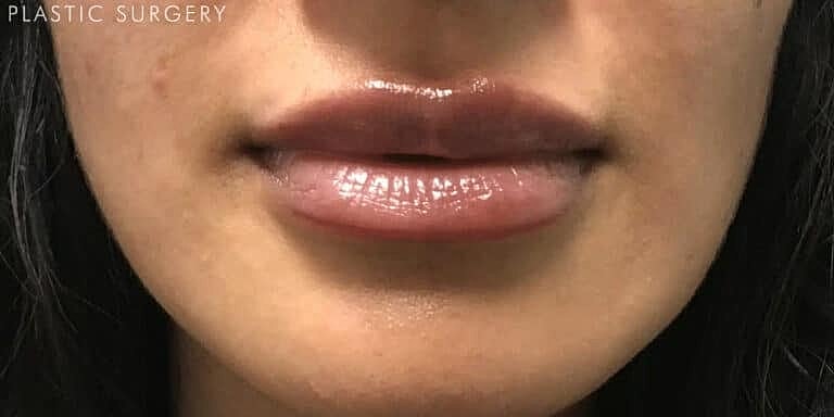 Juvederm Before & After
