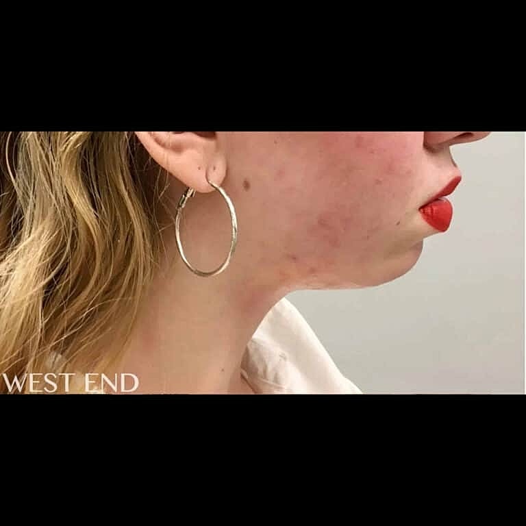 Juvederm Before & After