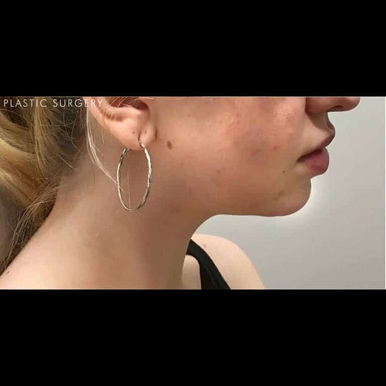 Juvederm Before & After