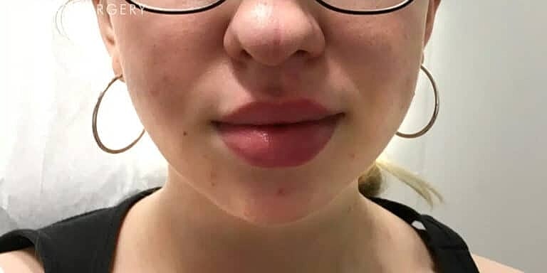 Juvederm Before & After