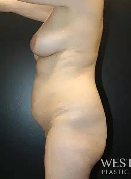 Mommy Makeover Before & After