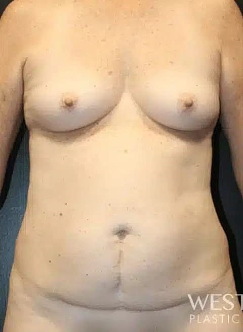 Mommy Makeover Before & After