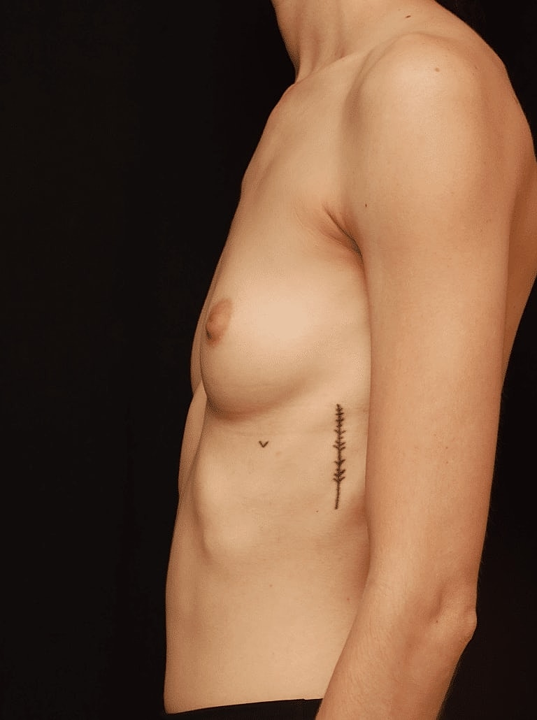 Breast Augmentation Before & After