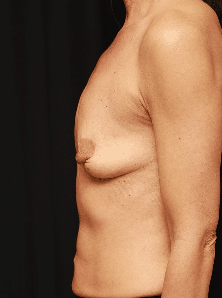 Breast Augmentation Before & After