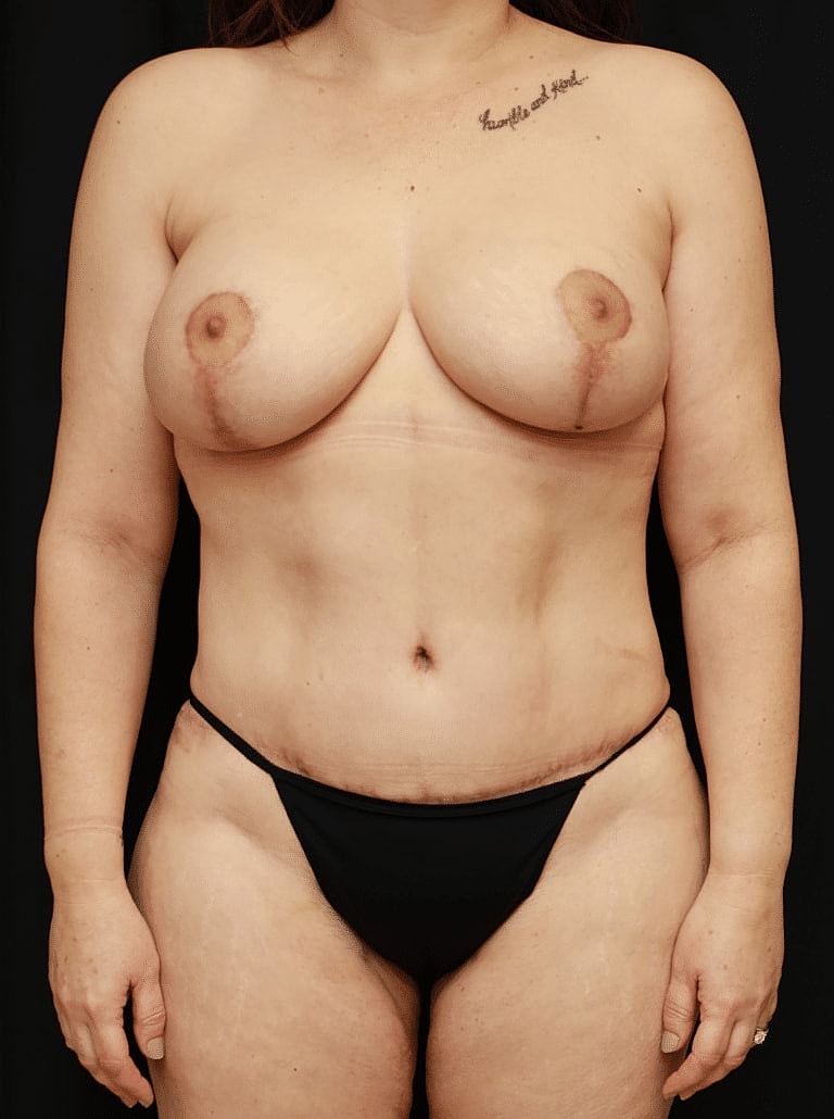 Breast Augmentation Before & After