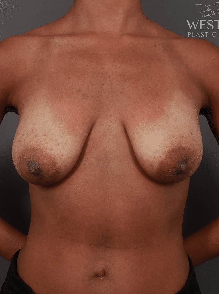 Breast Augmentation Before & After