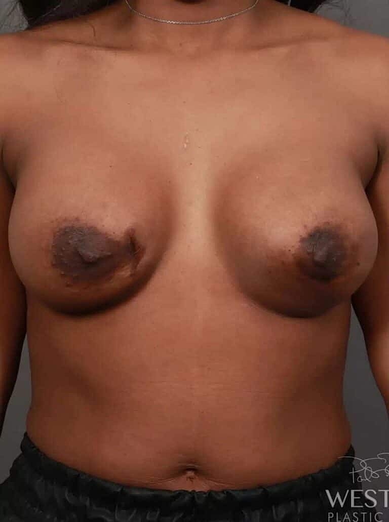 Breast Augmentation Before & After
