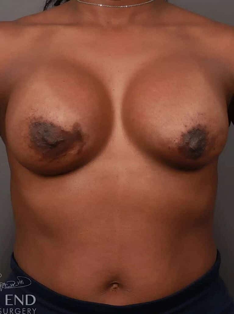 Breast Augmentation Before & After