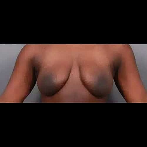 Breast Augmentation Before & After