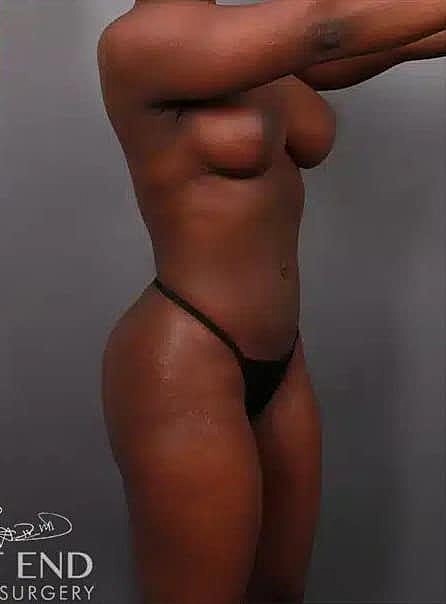 Breast Augmentation Before & After