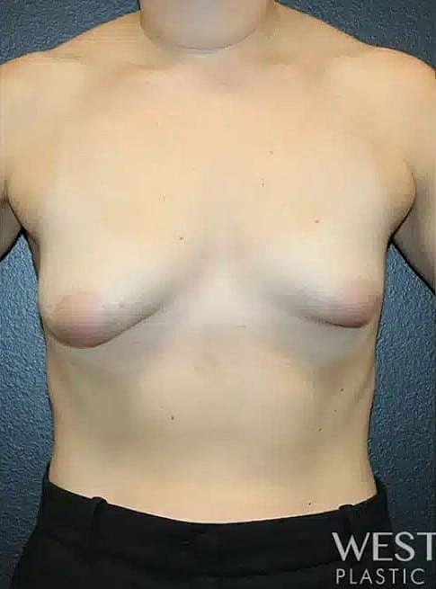 Breast Augmentation Before & After