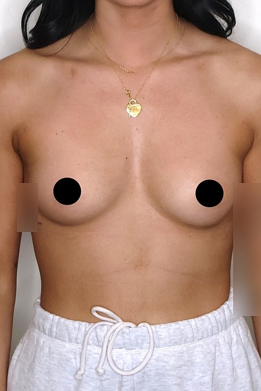 Breast Augmentation Before & After