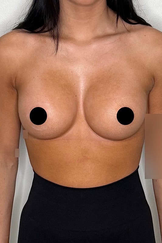 Breast Augmentation Before & After