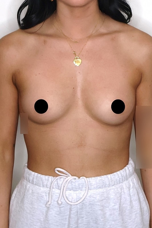 Breast Augmentation Before & After