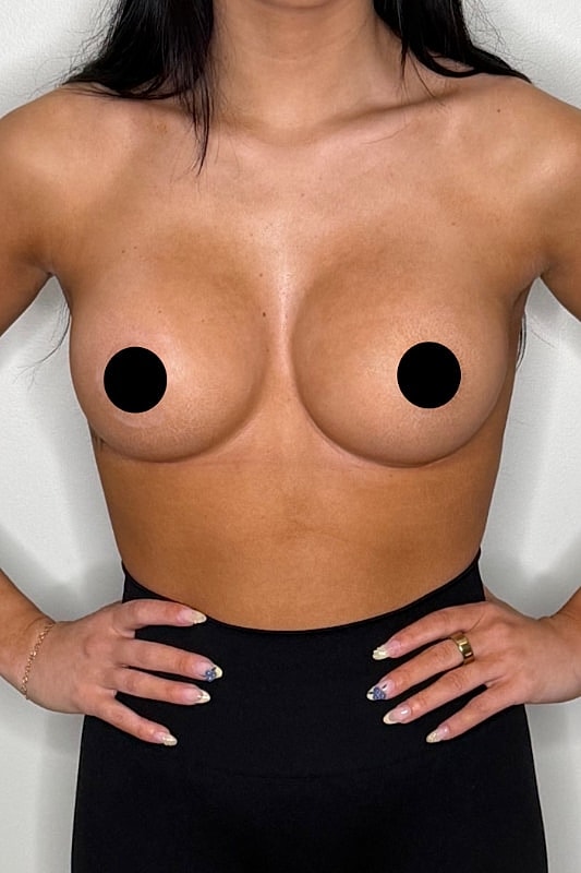 Breast Augmentation Before & After
