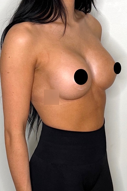 Breast Augmentation Before & After