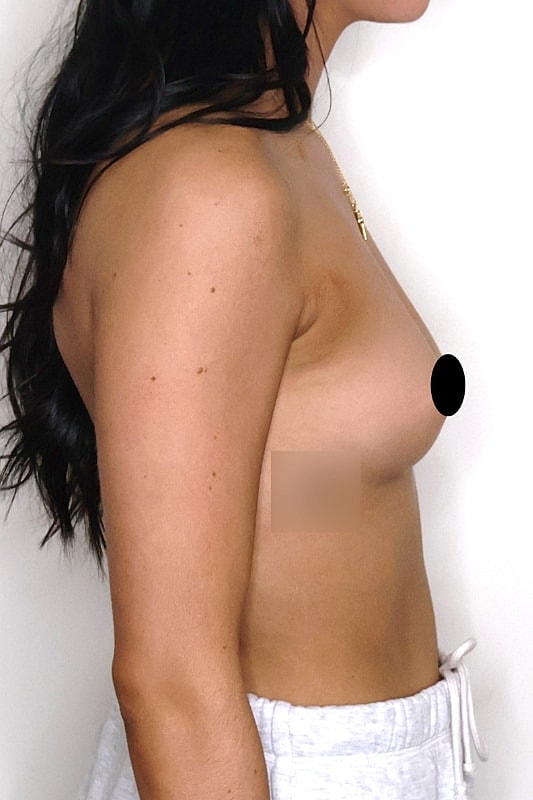 Breast Augmentation Before & After