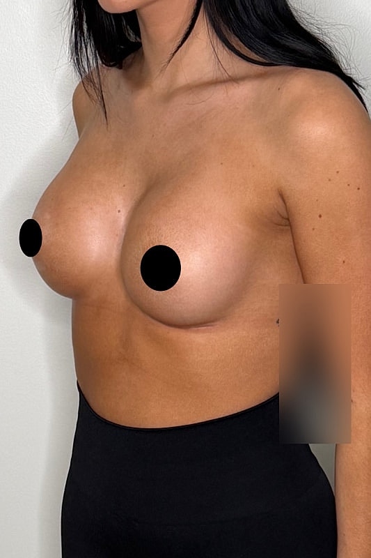 Breast Augmentation Before & After