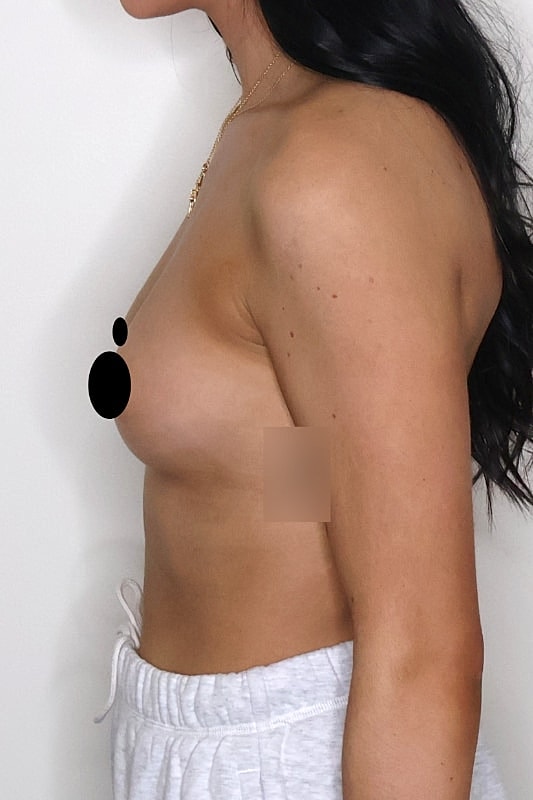 Breast Augmentation Before & After