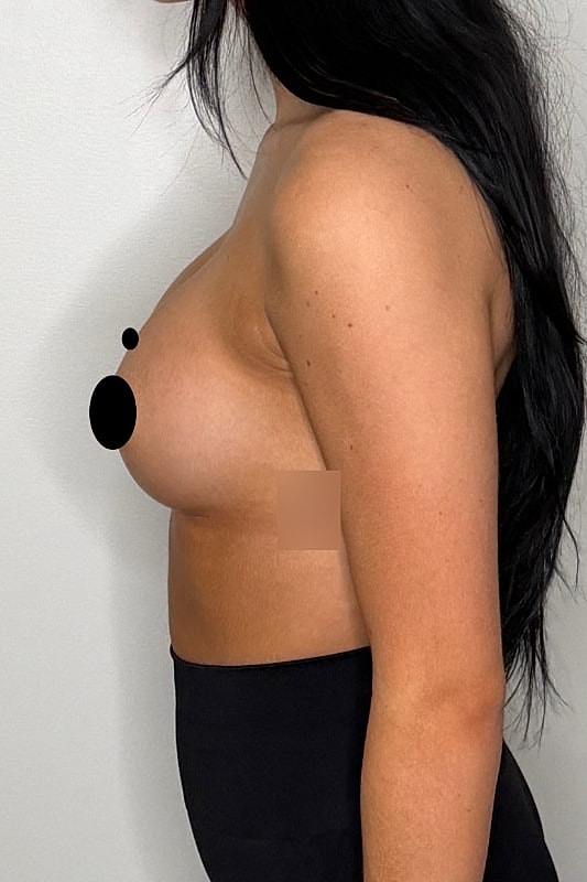 Breast Augmentation Before & After