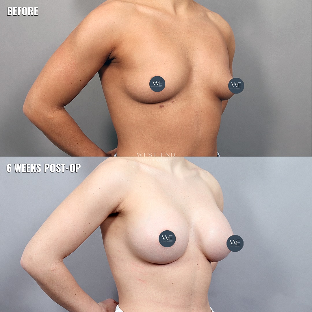 Breast augmentation before and after comparison.