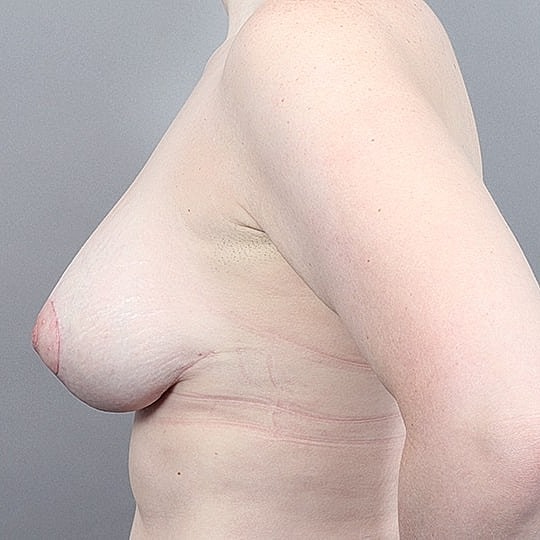 Breast Augmentation Before & After