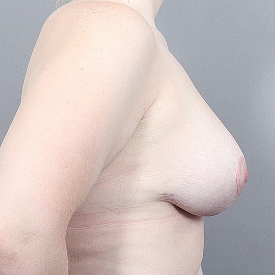 Breast Augmentation Before & After
