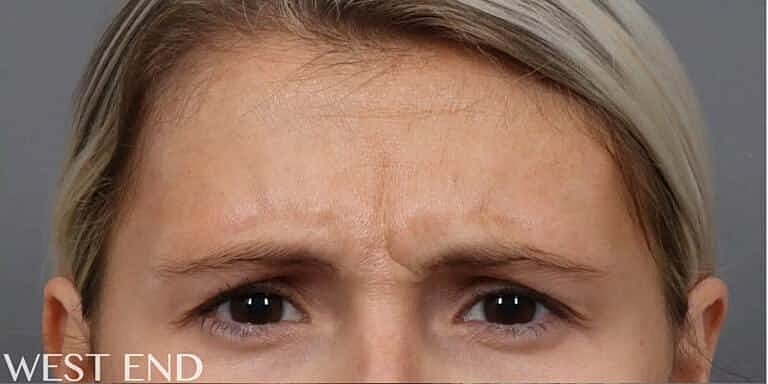Neurotoxins Before & After