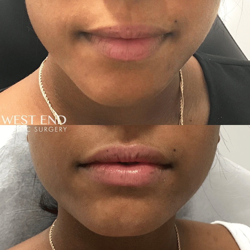 Before and after lip enhancement treatment results
