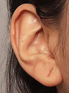 Earlobe Repair Washington DC