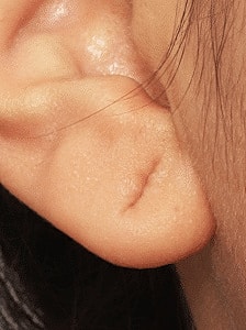Earlobe Reduction Washington DC