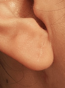Earlobe Reduction Surgery Washington DC
