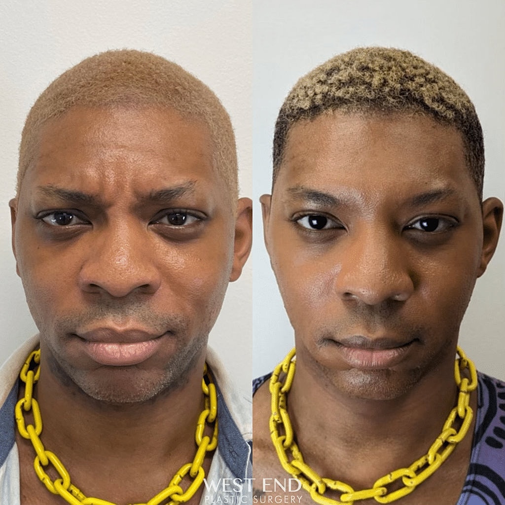 before and after dysport filler treatment Washington DC