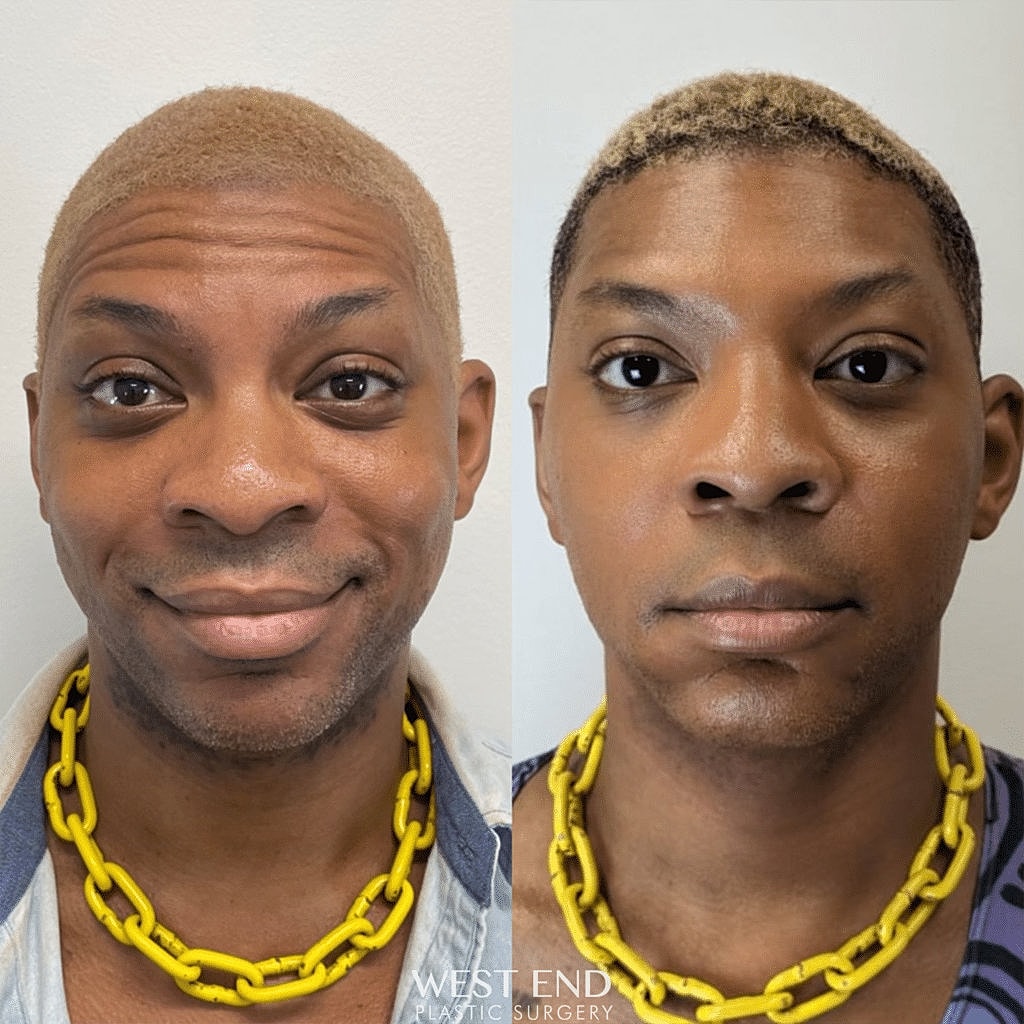 before and after dysport filler treatment Washington DC