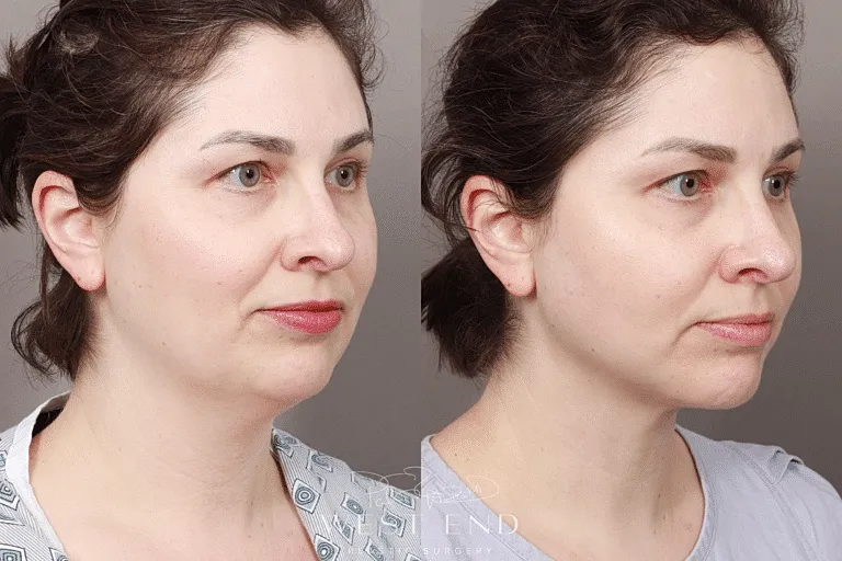 Renuvion Facial Surgery Washington DC