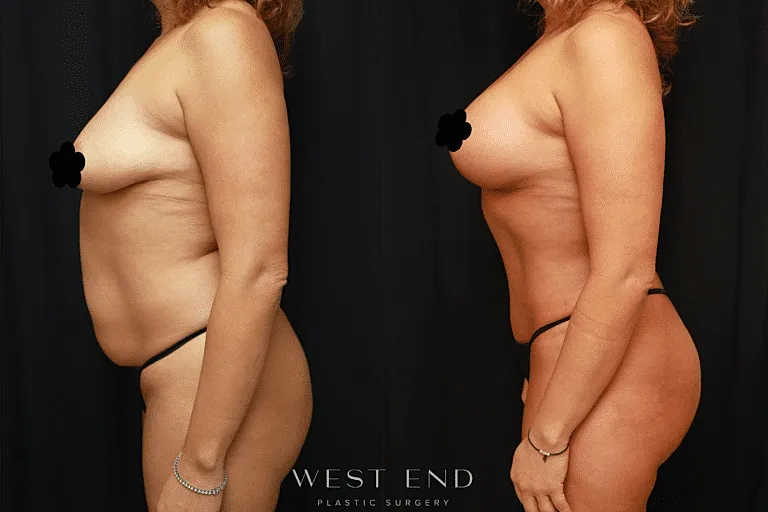Plastic surgery before and after comparison image